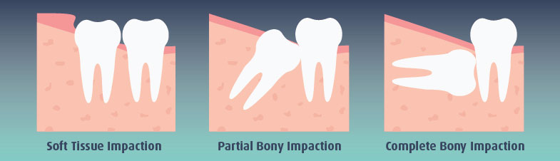 Types-of-Impaction-Illustration-web