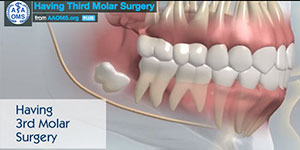 3rd Molar Surgery