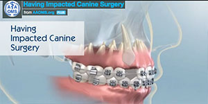Impacted Canine Surgery