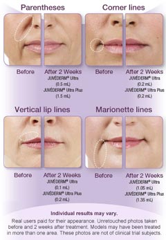 juvederm-graphic