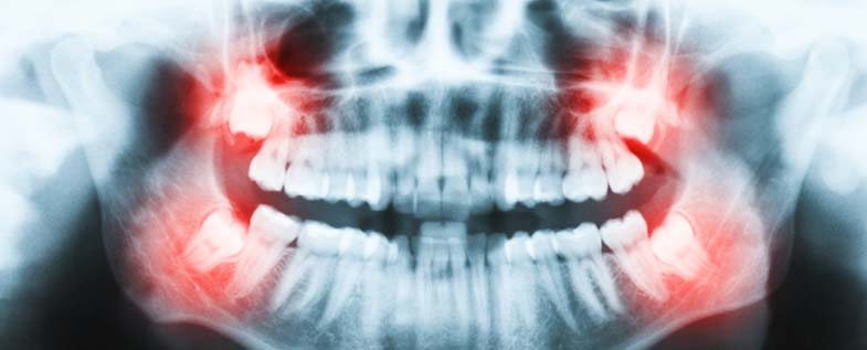 xray-Impacted-wisdom-teeth-780px
